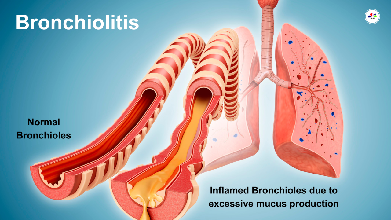 "Infant with bronchiolitis receiving medical care in a hospital setting."